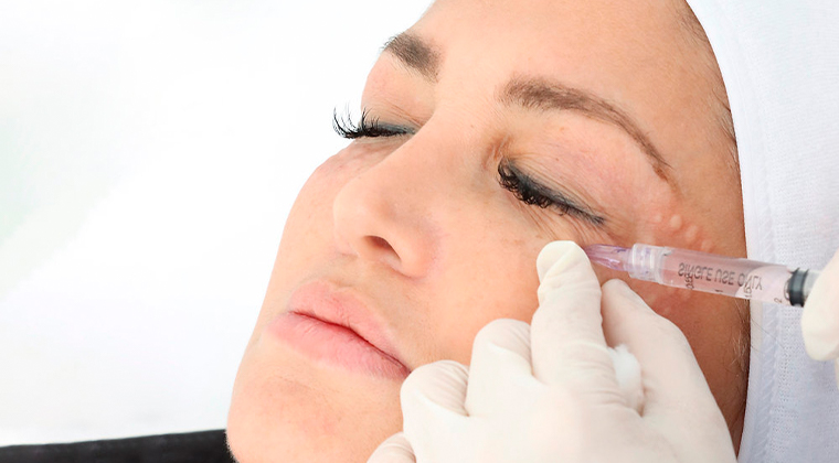 Mesoterapia facial con NCTF