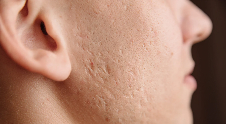 Acné y marcas de acné